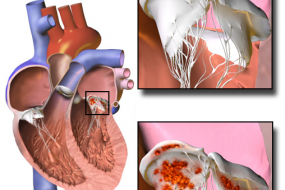 Prosthetic Valves 2: Valvular Problems image