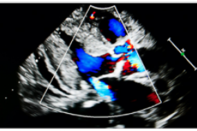 Aortic Regurgitation Top 10 image