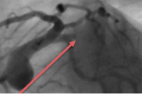 Total Occlusion Late After Myocardial Infarction image