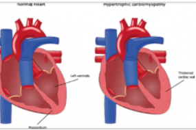 Hypertrophic Cardiomyopathy Top 10 image