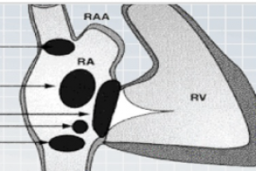 Left To Right Shunts: Atrial Septal Defects (ASD) image