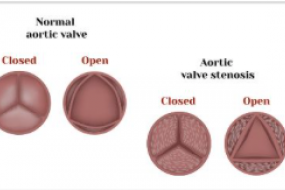 Aortic Stenosis image