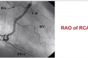 Coronary Angiography image