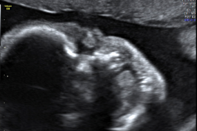 Ultrasound Artifacts 4: Normal Anatomic Variants & Aortic Dissection image