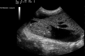 The Physics Of Ultrasound 3: Transducer Mechanics image