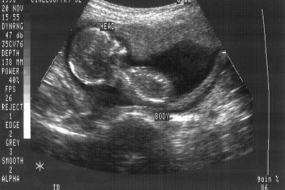 Ultrasound of in utero human fetus