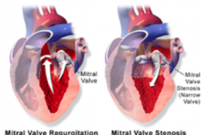 Mitral Valve 2: Mitral Regurgitation image