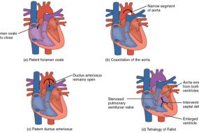 Critical Congenital Heart Disease, Part 2 image