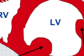 Mechanical Complications Of MI: Papillary Muscle Rupture, Free Wall Rupture, Ventricular  image