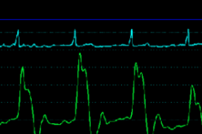 Mechanical Complications Of MI: Right Ventricular Infarction image