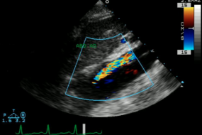 Thoracic Aorta 1: Aortic Cannulation And Aneurysms image