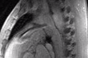 Left To Right Shunts: Patent Ductus Arteriosus (PDA) image