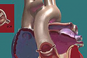 Bicuspid Aortic Valve And Pulmonic Stenosis image