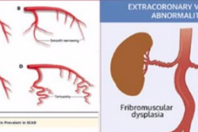 An Unusual Acute Coronary Syndrome image