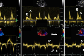 Diastolic Function 1: Diastolic Period Physiology image