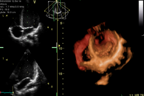 Right Ventricular Function 1: Geometry, Anatomy, And Physiology image