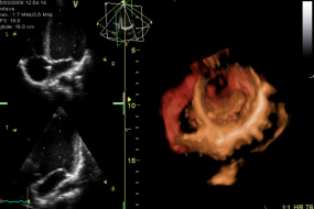 Right Ventricular Function 2: Echocardiographic Assessment image