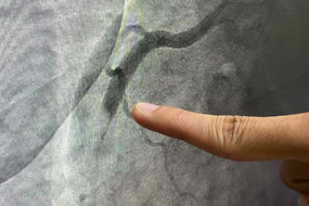 Coronary Angiography: Views and Pitfalls image